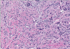 What type of breast cancer? What is the term for the characteristic cell pattern? 


 


What is the most common type of breast carcinoma to present as an occult primary? What is the histologic hallmark? 