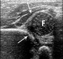 Hx:2-wk-old infant girl is referred for a hip clunk noticed by the pediatrician. She was the product of a NSVD and is otherwise healthy. PE= R hip Ortolani sign. A coronal US fig A. What is the next step in treatment? 1-Observ w/ repeat US in 1 mt...