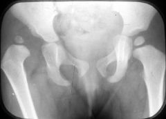 This patient has a right hip dislocation (DDH), as demonstrated by the positive Ortolani sign. Pavlik harness application is indicated for treatment. If the hip does not stay reduced within a few weeks, the next option is an arthrogram under anest...