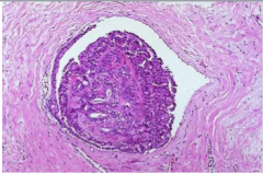 What is a benign epithelial neoplasm growing within a dilated duct composed of multiple branching fibrovascular cores? 


 


What two things are often present? Where are normally situated? Are they normally solitary? Which are commonly multiple...