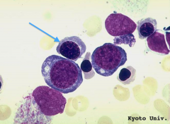 Polychromatophilic Erythroblast

- Stage: 2nd
- Cell size: medium (1.5x size of RBC)
- Nucleus: small, round, condensed chromatin
- Cytoplasm: grayish blue