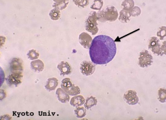 - Stage: 2
- Cell size: large, larger than a myeloblast
- Nucleus: large, round, delicate chromatin, prominent nucleoli
- Cytoplasm: abundant, heavily granulated by primary granules which obscure the nucleus