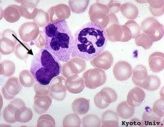 Metamyelocyte

- Stage: 4
- Cell size: smaller than myelocytes
- Nucleus: kidney-shaped / indented (<1/2 of diameter)
- Cytoplasm: pink granules