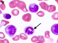 Mature Segmented Neutrophil

- Stage: 6
- Cell size: mature size
- Nucleus: multiple nuclear lobes (3-5) separated by thin nuclear filament, called a "segment"
- Cytoplasm: pink granules