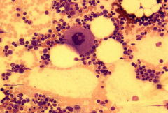 Megakaryocyte

- Size: large (up to 100 µm diameter)
- Nucleus: single, multi-lobated
- Cytoplasm: pink/gray, resembling platelets