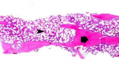 What can you see on a bone marrow core biopsy?