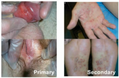 primary syphilis --> chancre- an ulcertaion with heaped up indurated edges that is painless (but can also be in oral area)


secondary syphilis --> generalized copper-colored, maculopapular rash on palms and soles of feetcan also have mucous patch...