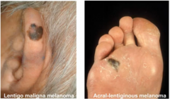Lentigo maligna melanoma --> sun exposed body parts in the elderly


Acral-lentiginous melanoma --> palms, soles of feet, and nail beds