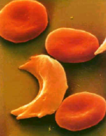Sickle Cell Disease - result of a hereditary hemoglobinopathy / structurally abnormal hemoglobin