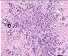 What do pathologists call something that looks very much like adenocarcinoma but isn't. 


 


The number of acini                                                                                    is __...
