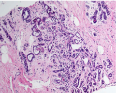 What is this? 


 


The involved terminal duct lobular unit is _____, and the acini are compressed and distorted by ______stroma, with _______ in some of the lumens. Unlike carcinomas, the acini are arranged in a ______ pattern, and the outer b...