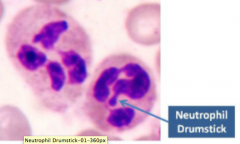 Who has neutrophils with this appearance? Why?