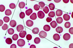 Platelets
- Purple blue particles
- Looks like debris
- Smaller than RBCs, less numerous, and variably shaped