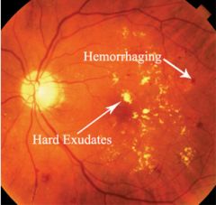 dilation of veins


microaneurysms



retinal edema



retinal hemorrhages