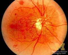 As damage increases --> vessels secrete inc amts of angiogenesis factor


Neovascularization covers optic nerve



hemorrhages protrude into vitreous chamber



vitreal hemorrhages threaten sight



Rx with laser photocoagulation and glycemic control