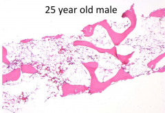 Hypocellular marrow for age