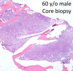 How do you describe the core biopsy?