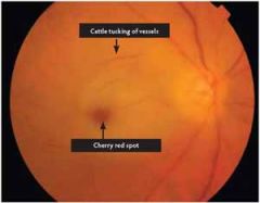 Ophtho emergency!


Sudden, painless, and unilateral loss of vision



No eye redness



Opthal exam shows pale retina, diminished perfusion, and "cherry red" spot at fovea



after dx, pt should undergo carotid artery imaging, echo, & eval for th...