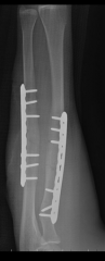 A 50-year-old woman sustains an open both bone forearm fracture seen in Figure A and undergoes the treatment seen in Figure B. During surgery the posterior interosseous nerve was transected and primary repair was attempted. One year following surg...