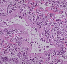 Snitt av alveole med forandringer som er typisk for hvilken sykdom?