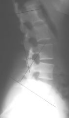 Lumbar Angle of Lordosis
