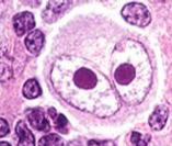 Hvilken celletype er dette et prakteksemplar av, og hvilken sykdom indikerer den?