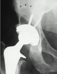 A 60-year-old male had a total hip replacement 8 years ago. Radiographs are shown in Figure A. When discussing the treatment options of acetabular revision versus isolated polyethylene exchange with the patient, what is the most common complicatio...