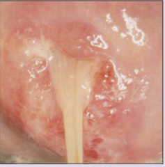 What does this appearance on pap smear indicate?