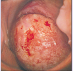 What does this appearance on pap smear indicate?