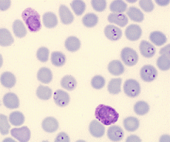 What type of malaria is shown in the image?