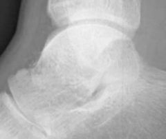 57-1-MCC & 2nd MCC for revision THA? MC direction
2-MC MoI for post vs ant dislocation of hip?
3-11 risk factors for dislocation surgeon 4 &  pt 7
4-xray finding impeding dislocation of hip?
5-Hawkins Classification of which bone?, significanc...
