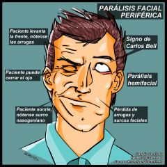 Parálisis de hemisferio de la cara