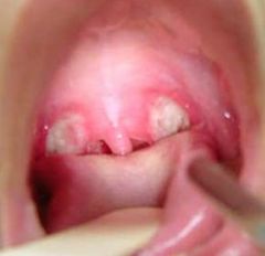 The patient in this image presented with fever 38.5C, tachycardia 110/min and severe sore throat.


If a swab is taken what is likely to grow?