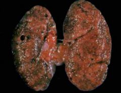 Interstitial nephritis resemblant
Shrinking and pitting of the capsule, cortical thinning and fibrosis