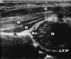 : Figure A depicts an ultrasound of a newborn infant, which is routinely used in the screening and monitoring for hip dysplasia. The structure labeled by the number 4 is the labrum. 

Harke et al reviewed the management of congenital dislocation...