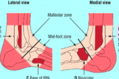 Ottawa Ankle Rules
- decide if you need to send someone for an x ray
- want to spend less money on x rays
 
pain at any of these 4 spots or can't walk (testing for fractures)
a) posterior edge or tip of lateral malleolus
b)posterior edge or tip of...