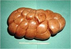Swollen and pale kidneys
Large with a smooth to granular capsular surface