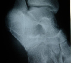 A 14 year-old girl has chronic foot pain which has failed to respond to previous surgical coalition resection and soft tissue interposition. A radiograph of her foot is shown in Figure A. A CT scan demonstrates a talocalcaneal coalition with almos...