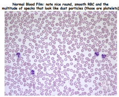 normal vs. TTP blood film 