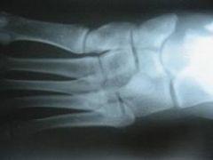 The patient presents with symptoms and imaging studies consistent with a navicular stress fracture. Initial mangement of these injuries consists of non weight bearing cast immobilization. 

Khan et al found that patients managed with a minimum o...