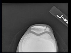 Hx: 14yo high school running back strikesL knee on an opposing players helmet during practice. He is able to continue playing for 10 more minutes before seeking medical attention. On PE= has soft tissue swelling at the anterior knee and early ecch...