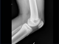 pt has a benign exam and radiographs demonstrate a bipartite patella. No further evaluation is necessary and symptomatic treatment with RICE and return-to-play as tolerated is most appropriate.Ans4