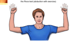 Cervical Orthopedics:
Thoracic Outlet Syndrome (TOS)
Roos test and Doorbell sign