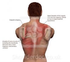 










–Serratus
anterior/long thoracic n.
(C5,6,7) 

–Treat
the neck!
 –Push-up
plus exercise