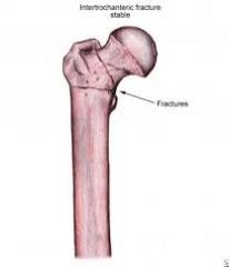 On the proximal femur, looks like the anatomic neck similar to the proximal humerus.