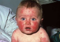 This rash presented in an otherwise when child. What is the likely diagnosis?