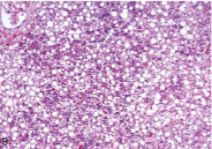 What is accumulated in these hepatocytes?


What disease does this cause?