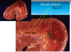 Renal Infarcts - was normally supplied with blood and only the lacking area is affected by the necrosis not the entire organ 