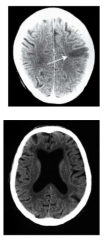 Computed tomography (CT) uses x-rays to visualize large structures in the brain