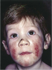 Erythematous papules and vesicles with weeping, oozing and crusts. Pruritus. Often associated with family history of allergies.